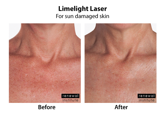 Before And After Limelight Laser Sun Damage Neck And Chest 3