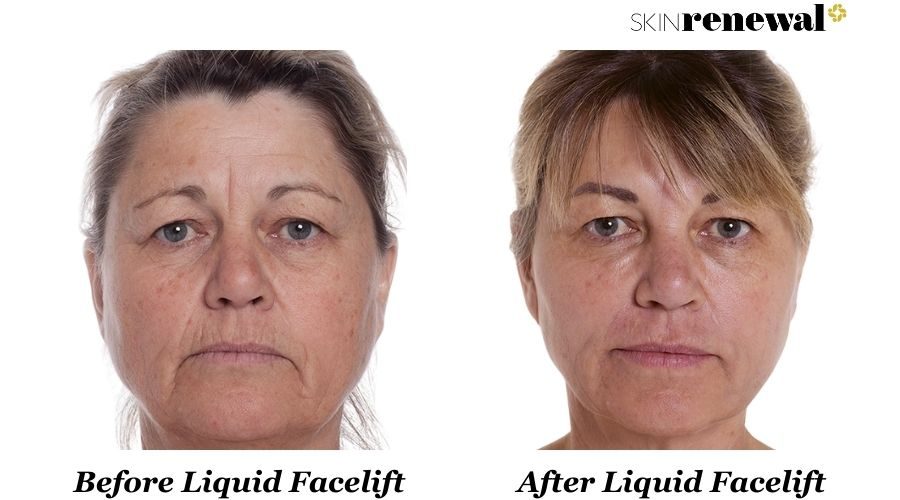 Charmaine Liquid Facelift Before And After