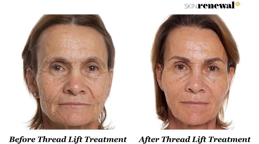 Yvonne Before And After Thread Lift