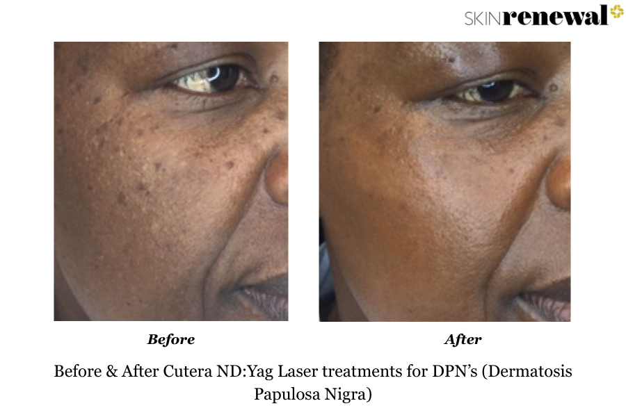 DPN ND Yag Laser Right Before and After