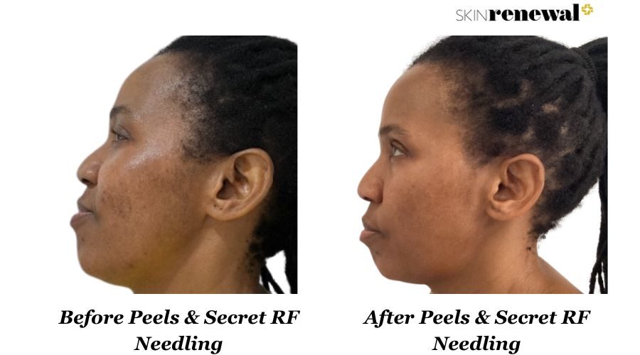 Pigmentation Peels Secret Rf Left