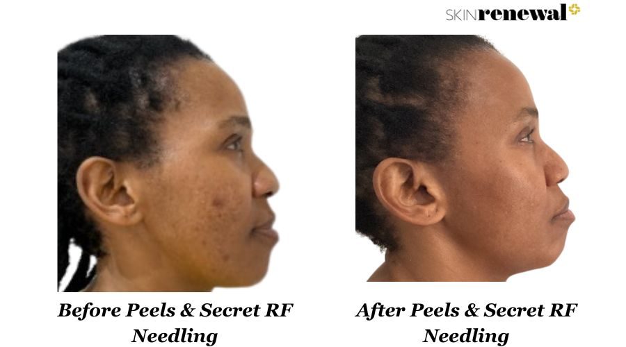 Pigmentation Peels Secret Rf Right