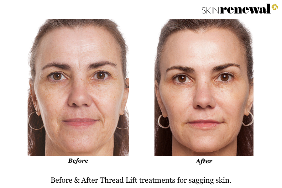Sagging Skin Thread Lift Before and After